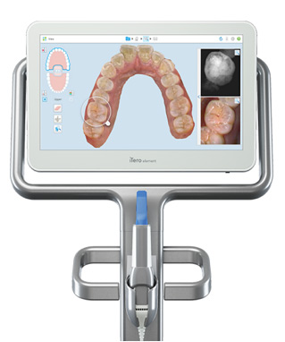 Itero Intraoral Scanner in 