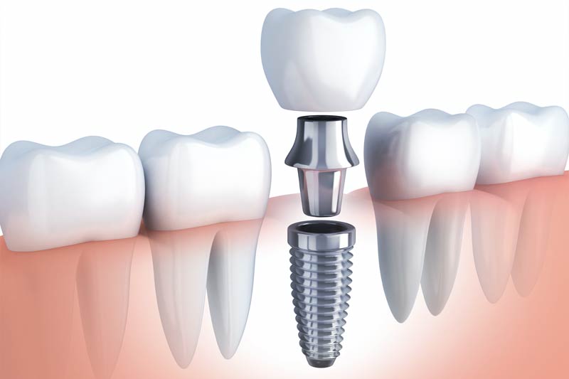Implants Dentist in Hoffman Estates