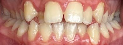 Crowding. Crossbite. gap Crowding. Crossbite. gap