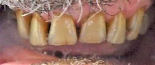 upper arch before upper arch before